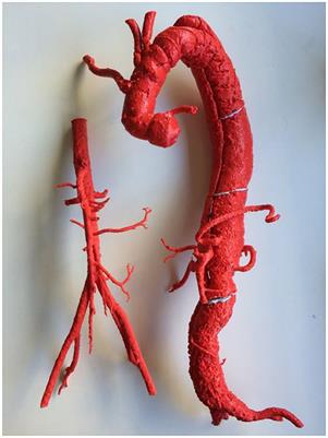 Accessing 3D Printed Vascular Phantoms for Procedural Simulation